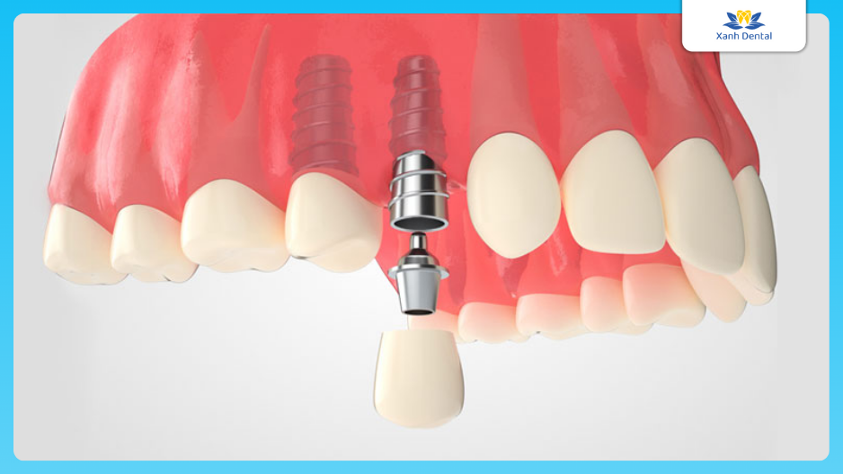 Trồng răng Implant giá bao nhiêu