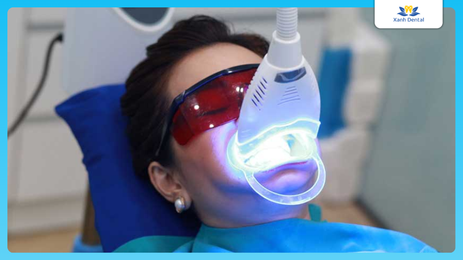 Tẩy trắng răng bằng phương pháp sử dụng tia Laser