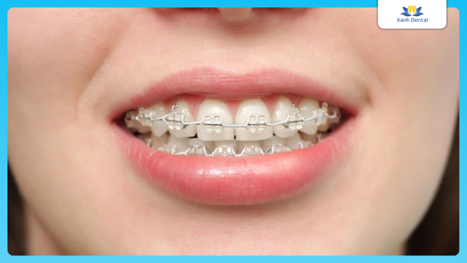 Niềng răng ở đâu tốt?