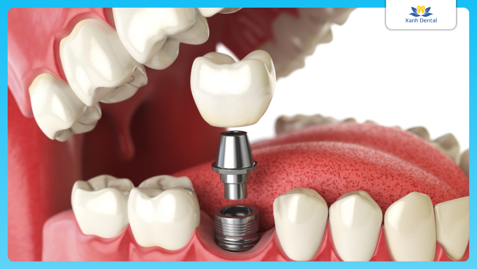 Ưu điểm trụ Implant ETK