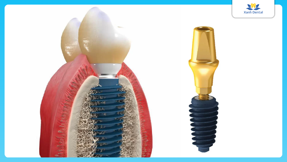 Trụ Megagen Hàn Quốc có độ tương thích với răng cao