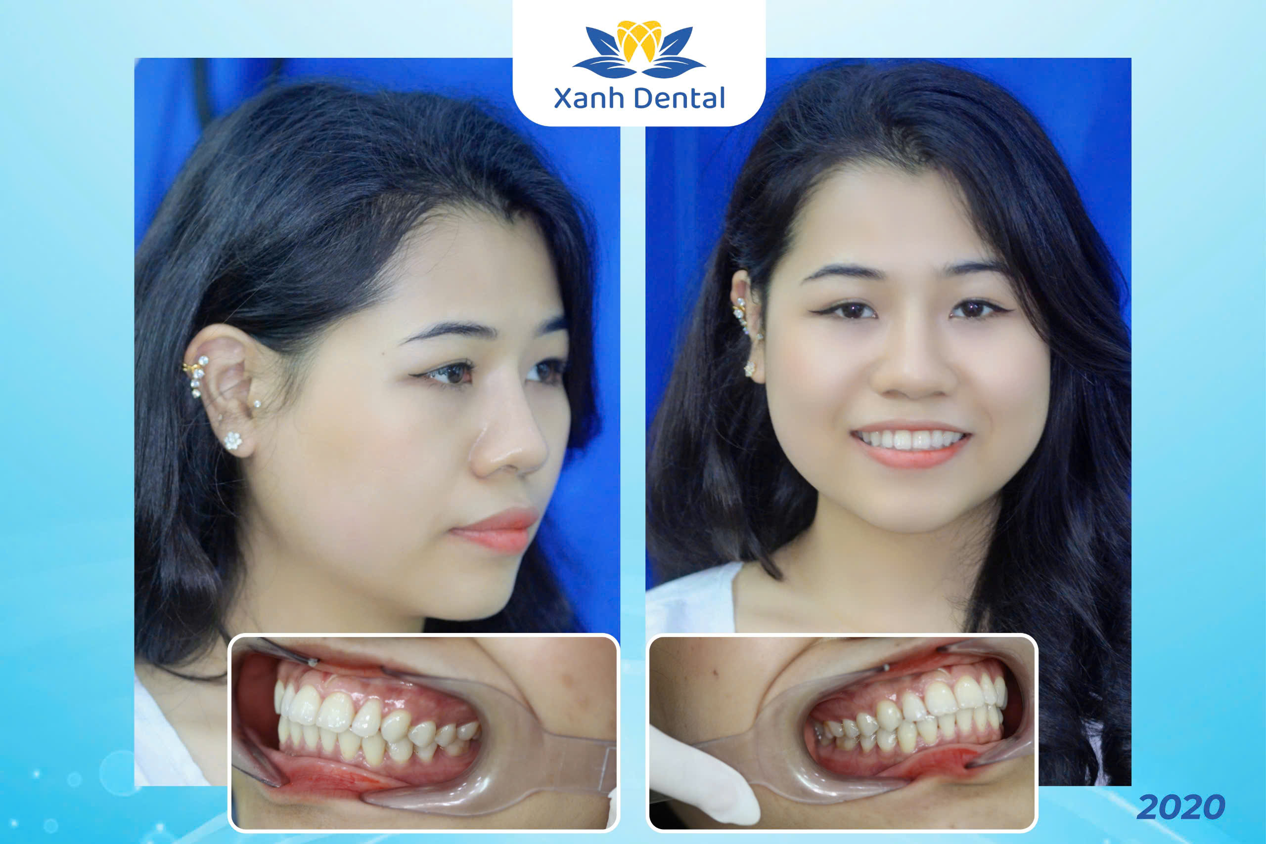 Tình trạng răng chị Hải Yến trước khi niềng Invisalign