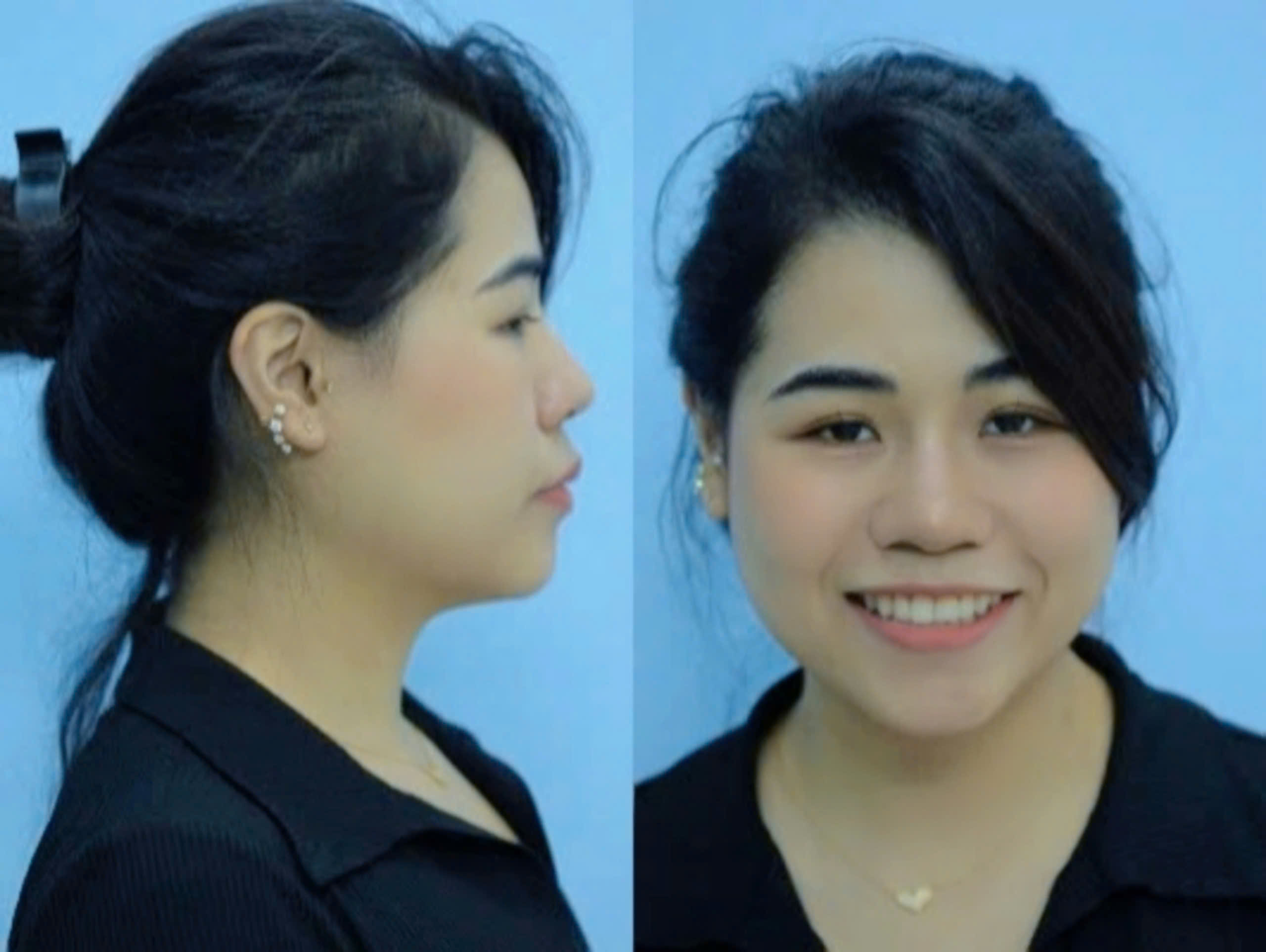 Tình trạng chị Hải Yến sau 2 năm niềng răng Invisalign