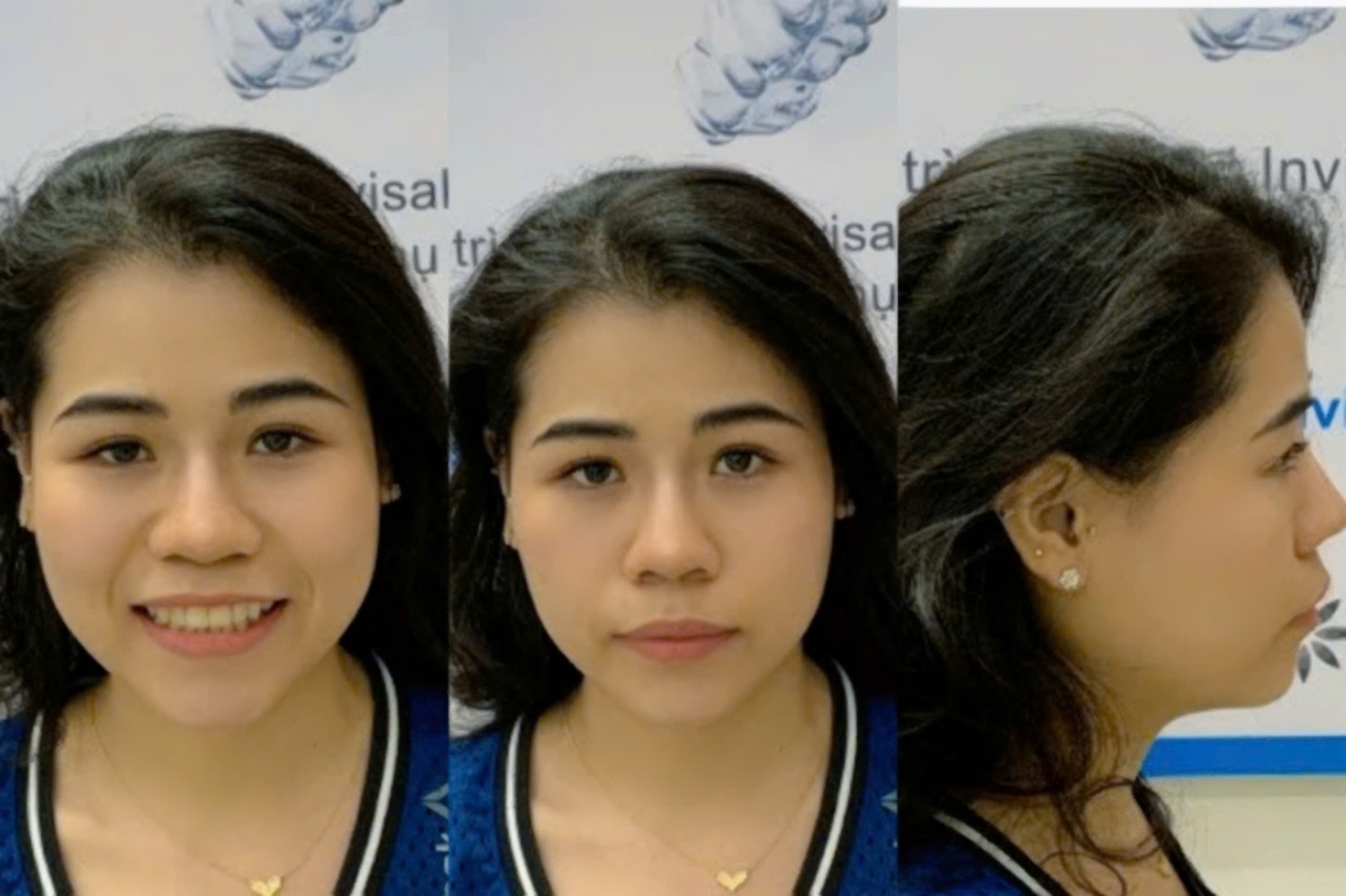 Tình trạng răng năm thứ nhất chị Hải Yến niềng răng Invisalign