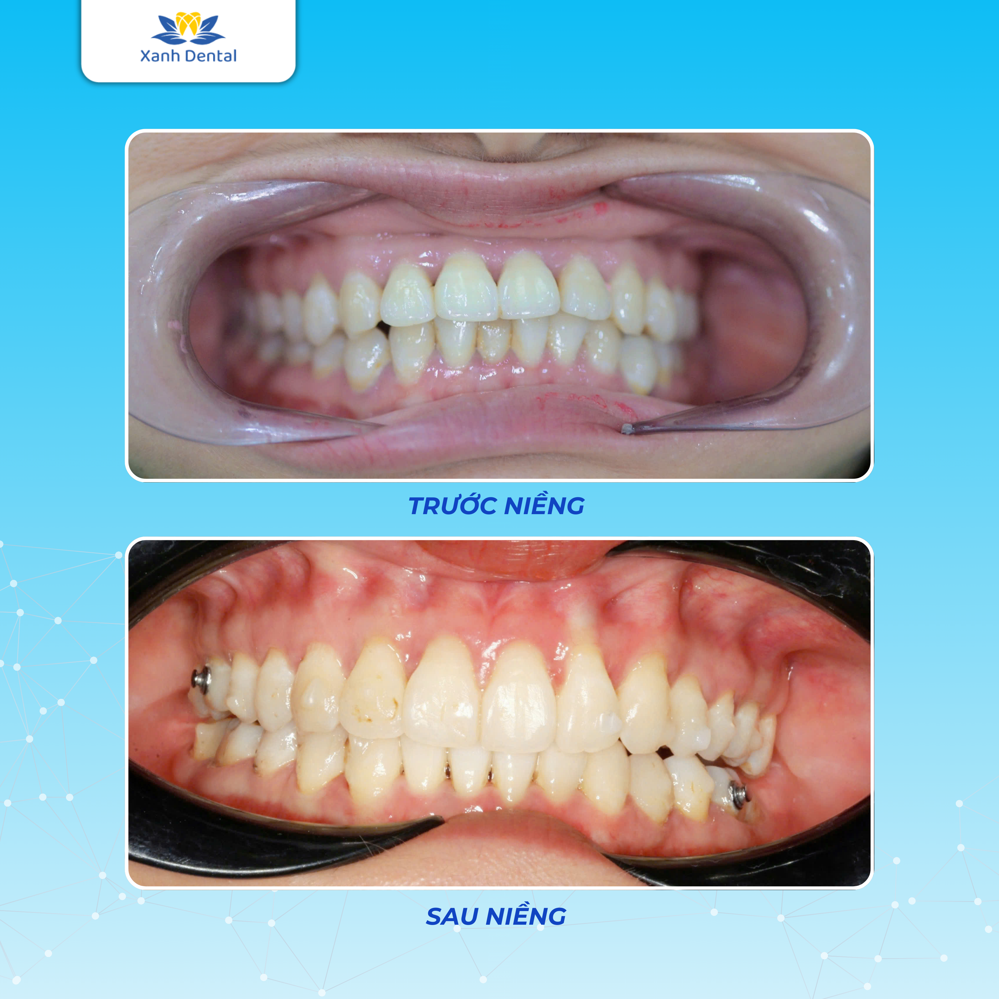 Răng khách hàng Lưu Kim Anh trước và sau niềng răng trong suốt