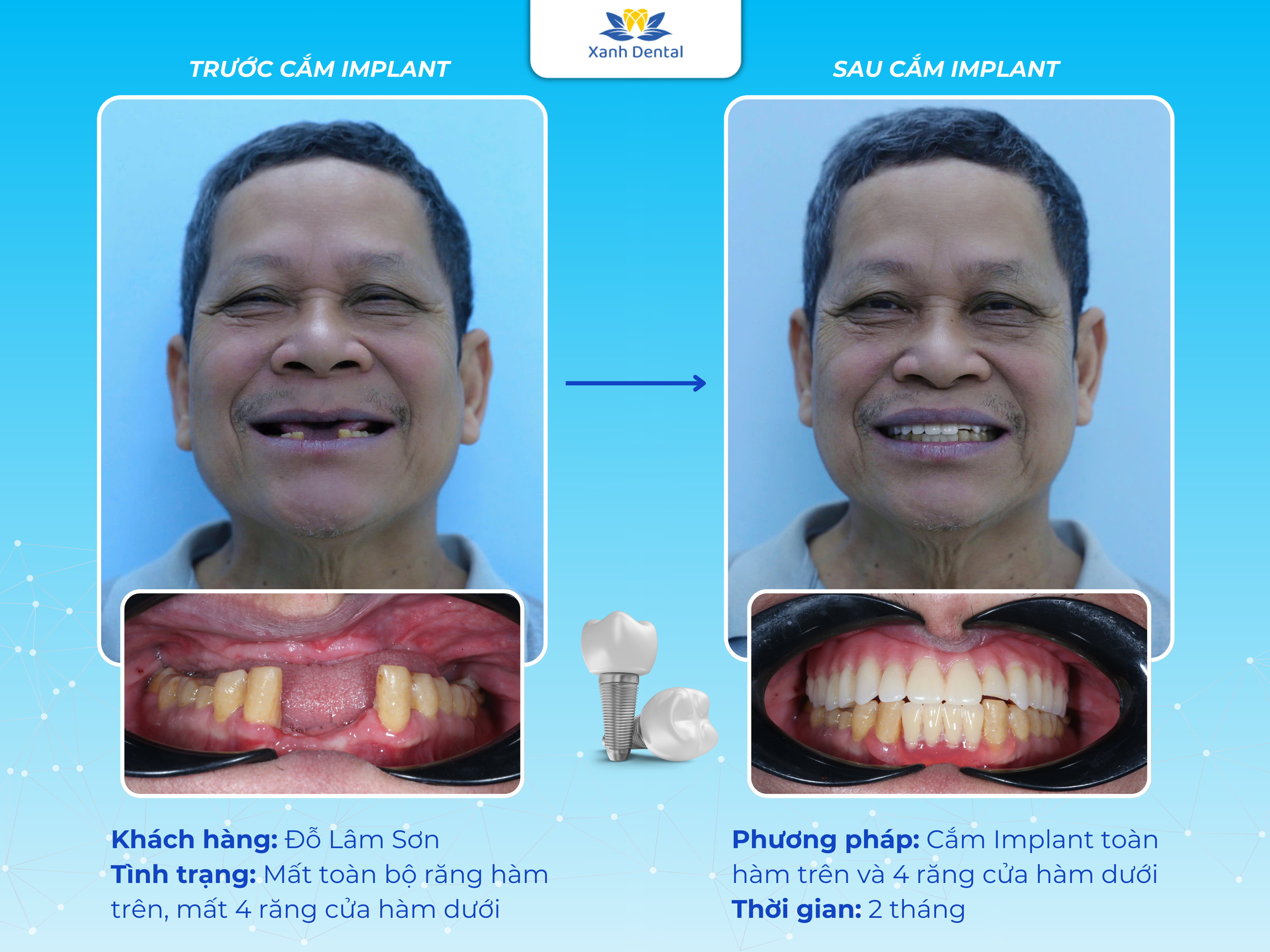 Kết quả điều trị của Chú Sơn sau 2 tháng cắm All-on-4 Implant