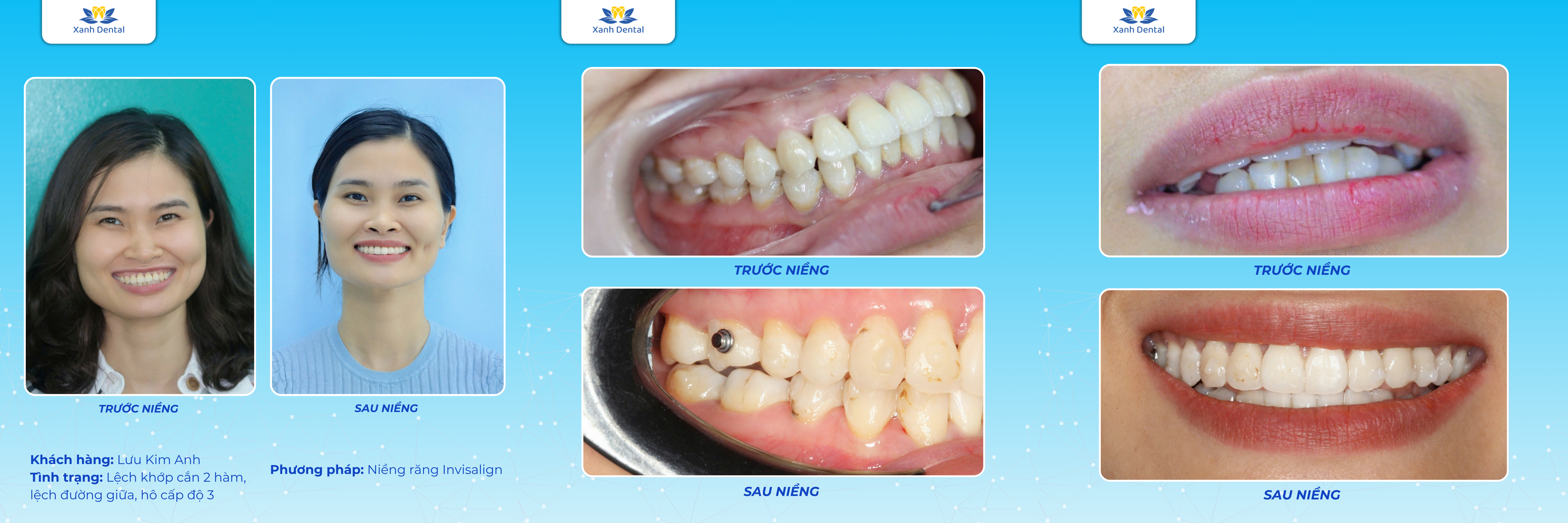 Khách hàng Lưu Kim Anh sau 2 năm niềng răng Invisalign