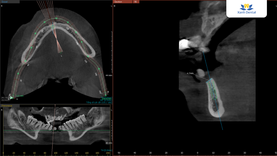 Lên kế hoạch điều trị Implant cho chú Sơn