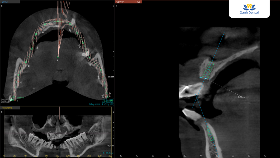 Lên kế hoạch điều trị Implant cho chú Sơn