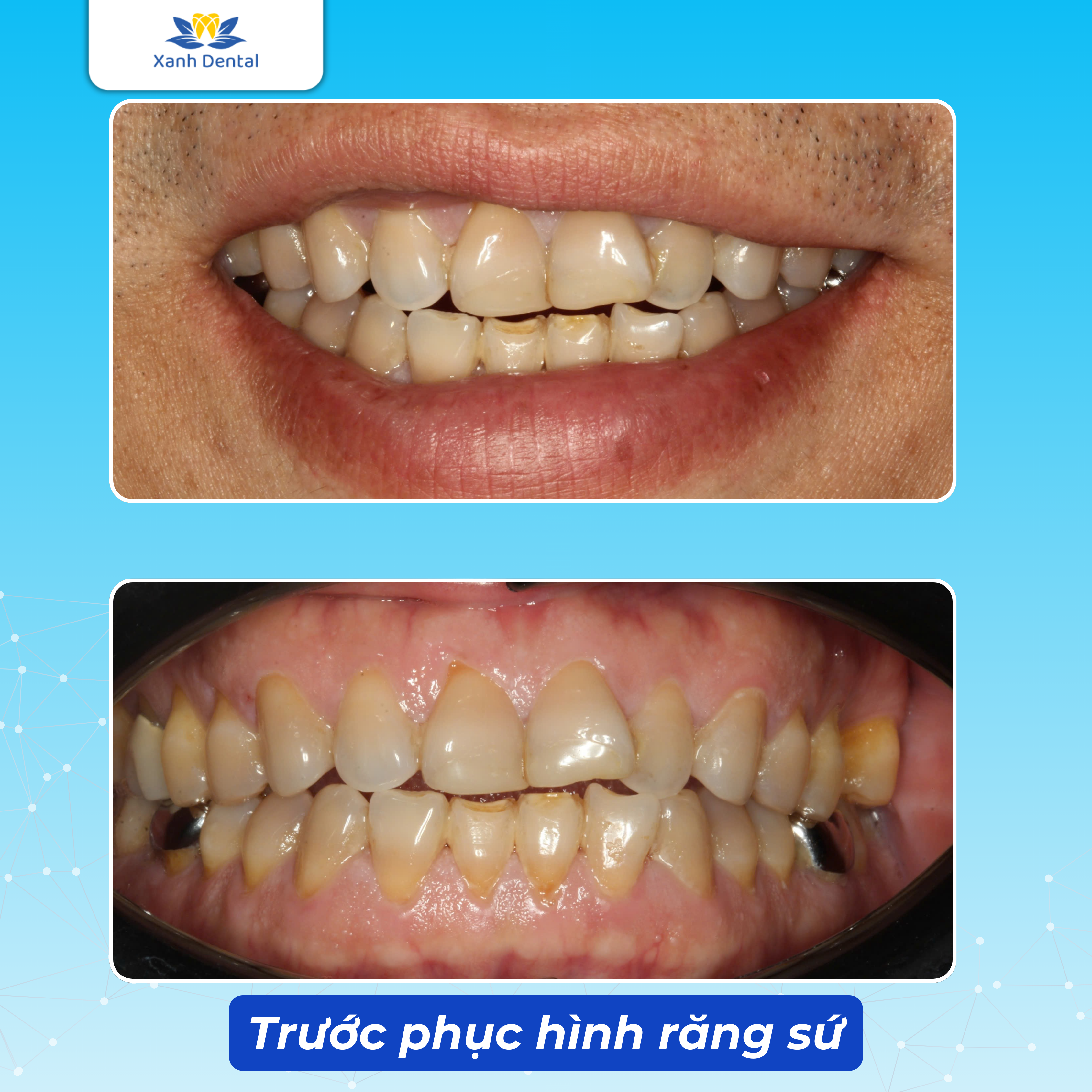 Nụ cười Eric Truong trước khi thẩm mỹ răng sứ Orodent