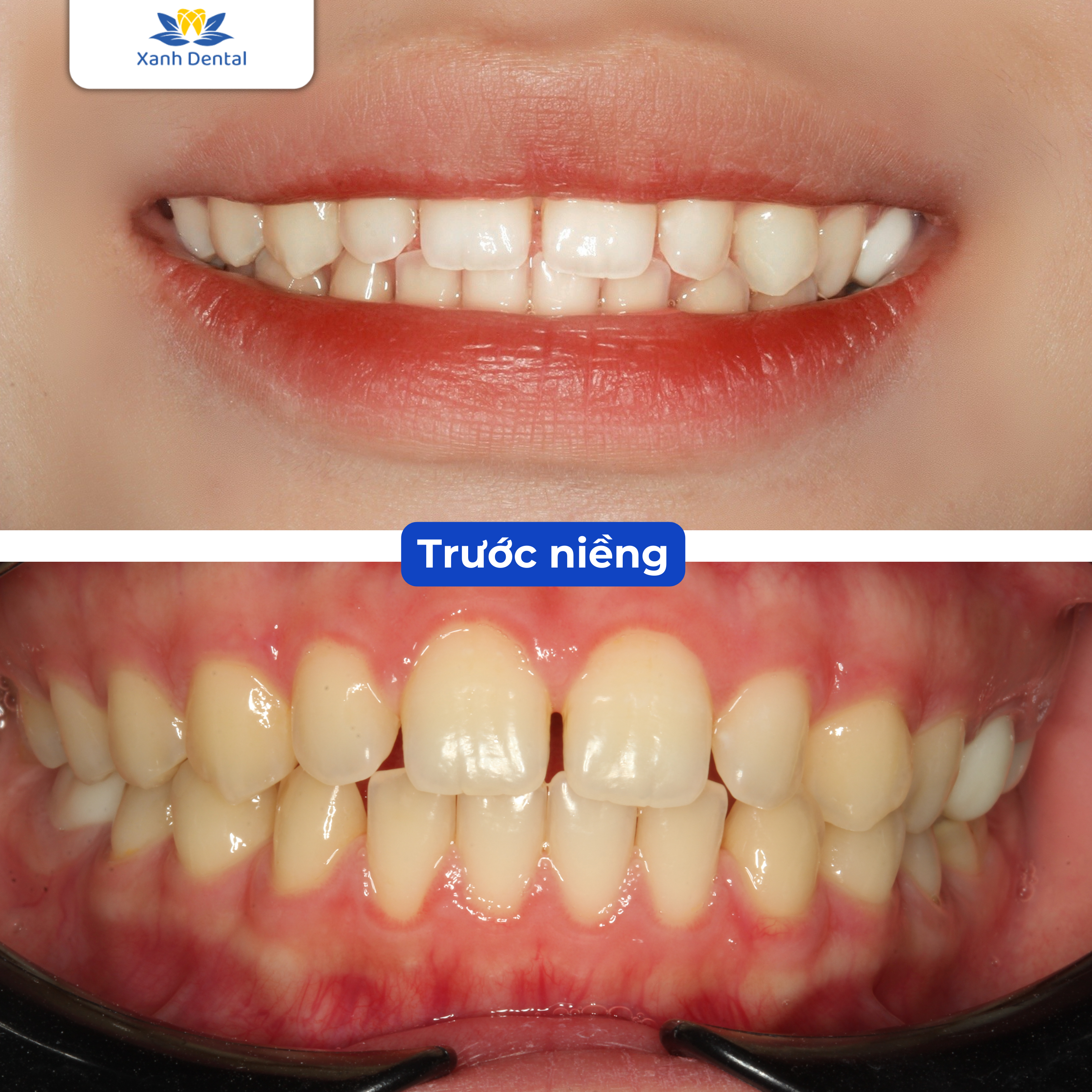 Tình trạng Linh Thương trước niềng