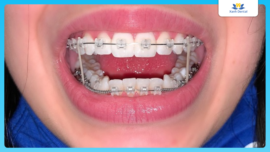 Định nghĩa về niềng răng. Niềng răng là gì?