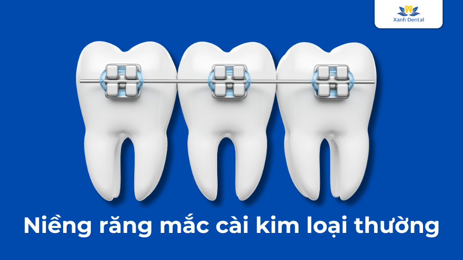 Niềng răng mắc cài kim loại thường