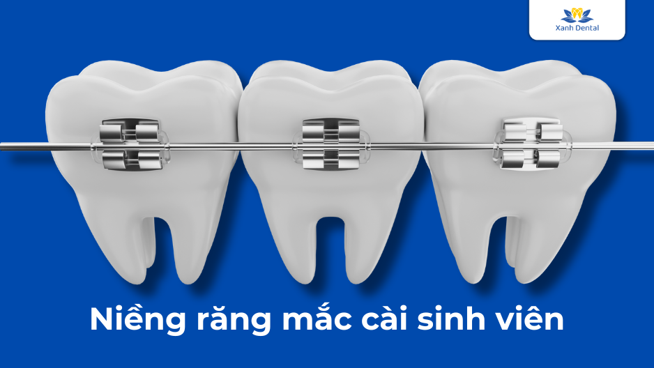 Niềng răng mắc cài sinh viên