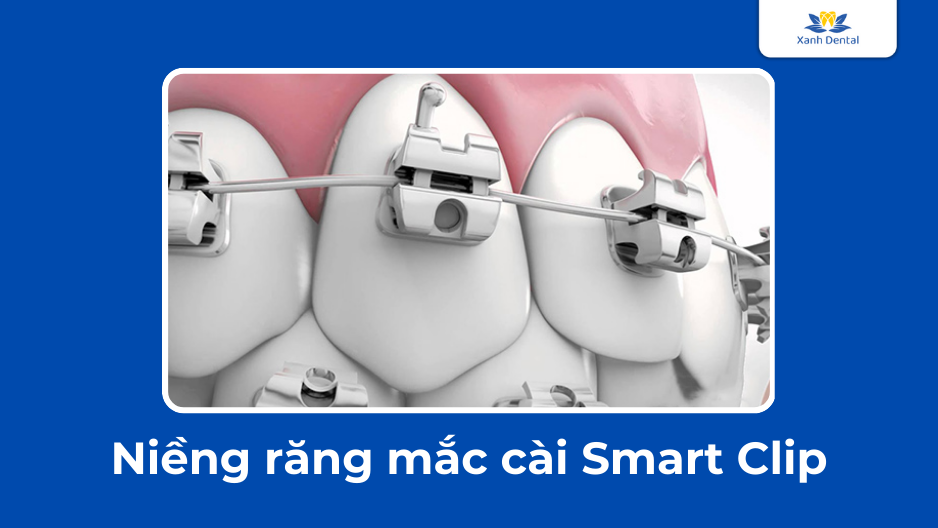 Niềng răng mắc cài Smart clip