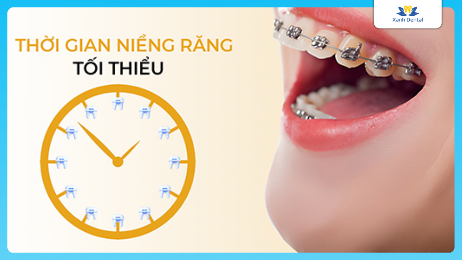 Thời gian niềng răng