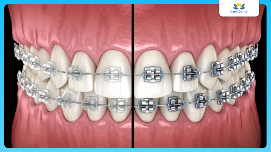 Niềng răng chỉnh nha trong làm răng thỏ