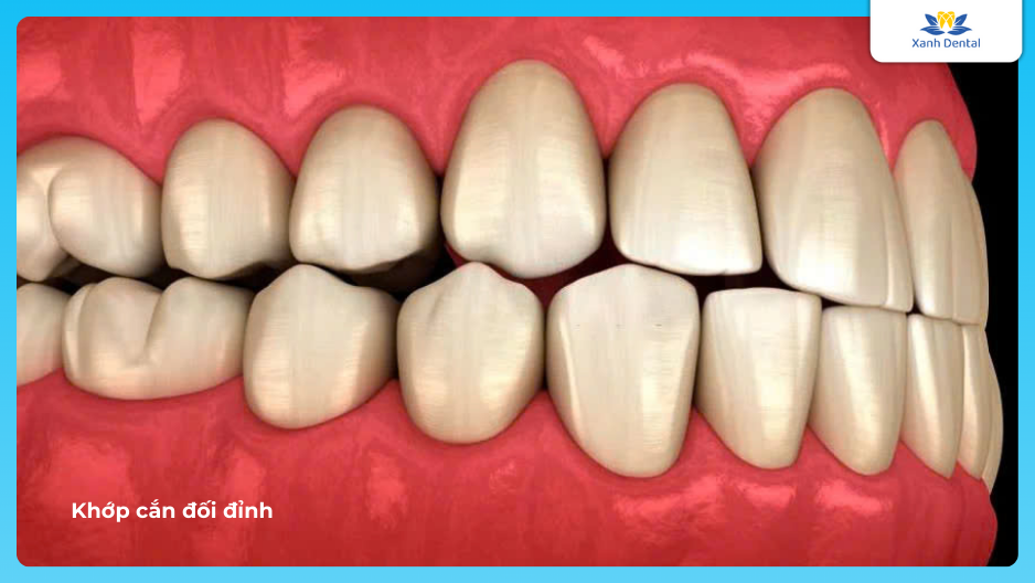 Khớp cắn đối đỉnh