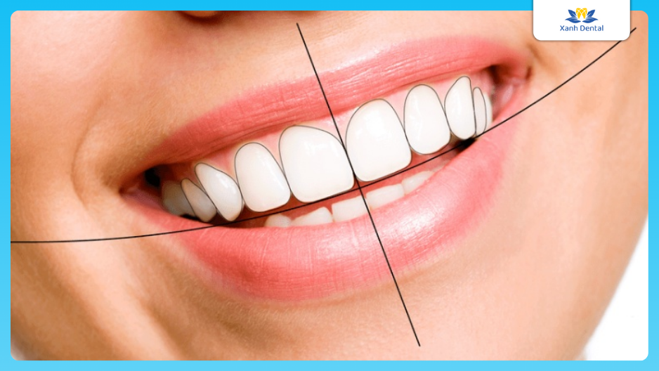 Nụ cười hoàn hảo với khớp cắn chuẩn