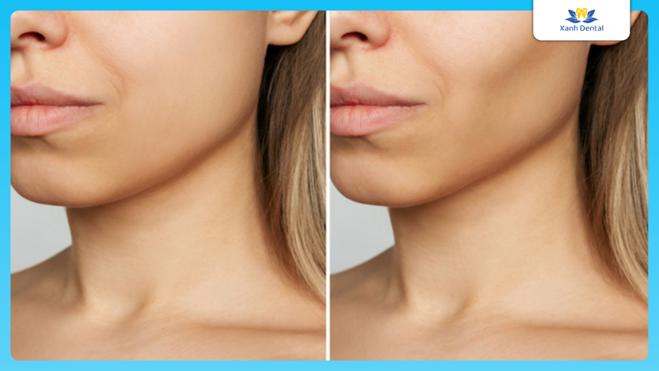 Niềng răng có hóp má không?