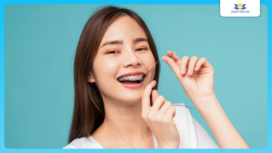 Niềng răng hóp má bao lâu thì hết?