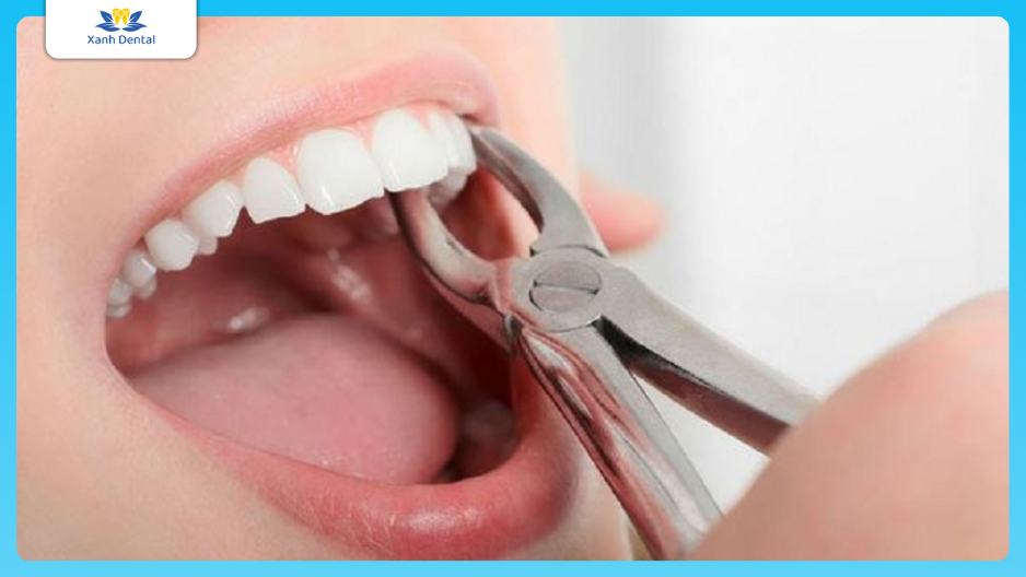 Niềng răng có phải nhổ răng không?