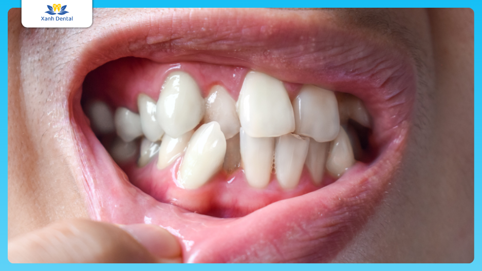 Răng mọc lệch, sai khớp cắn