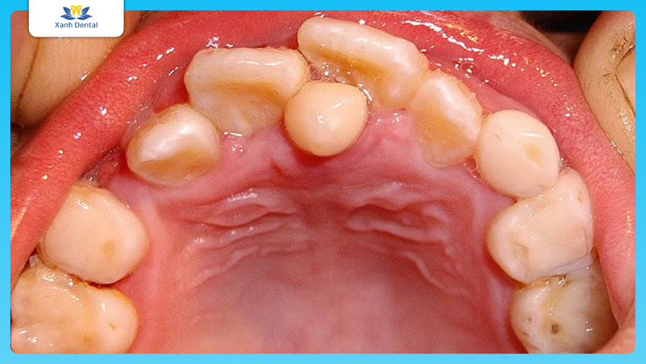 Răng mọc thừa, răng mọc lệch