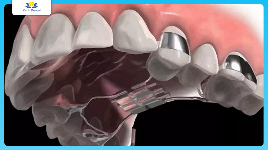 Nong hàm để tạo khoảng trống