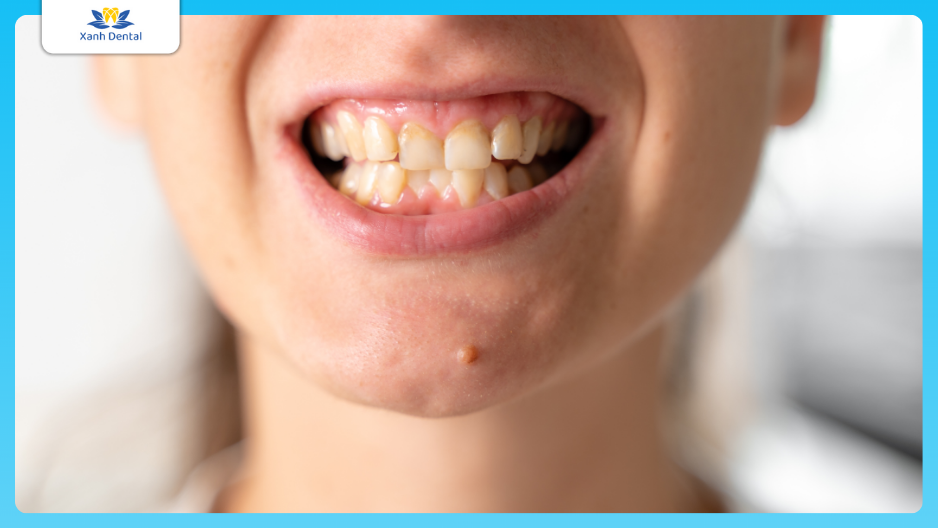 Niềng răng có giúp hết mặt lệch không