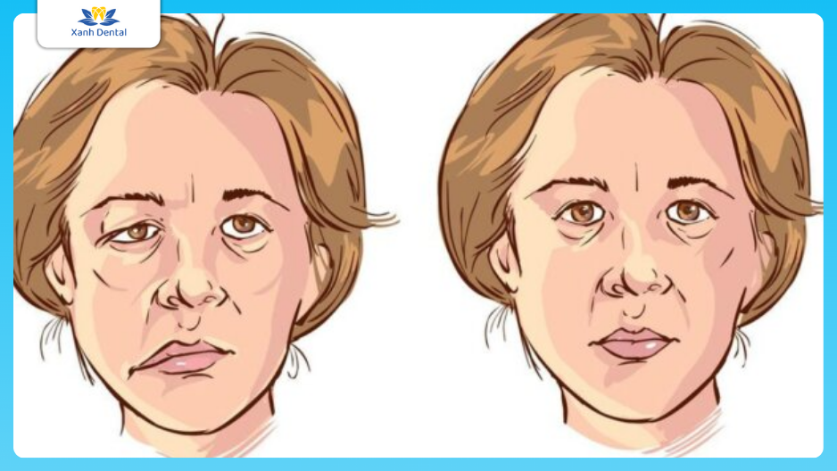 Tình trạng mặt lệch do xương