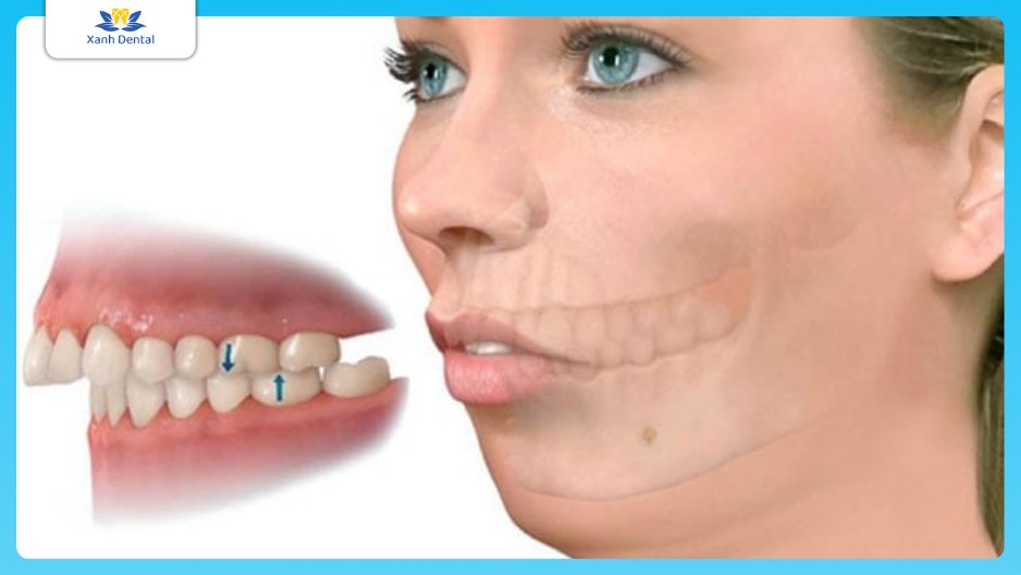 Mặt lệch do xương hàm