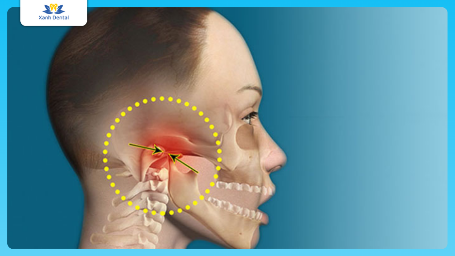 Mặt lệch do nhai 1 bên