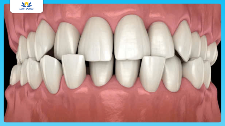 Chỉnh nha răng khấp khểnh