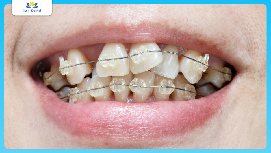 Tác hại của chỉnh nha răng khấp khểnh