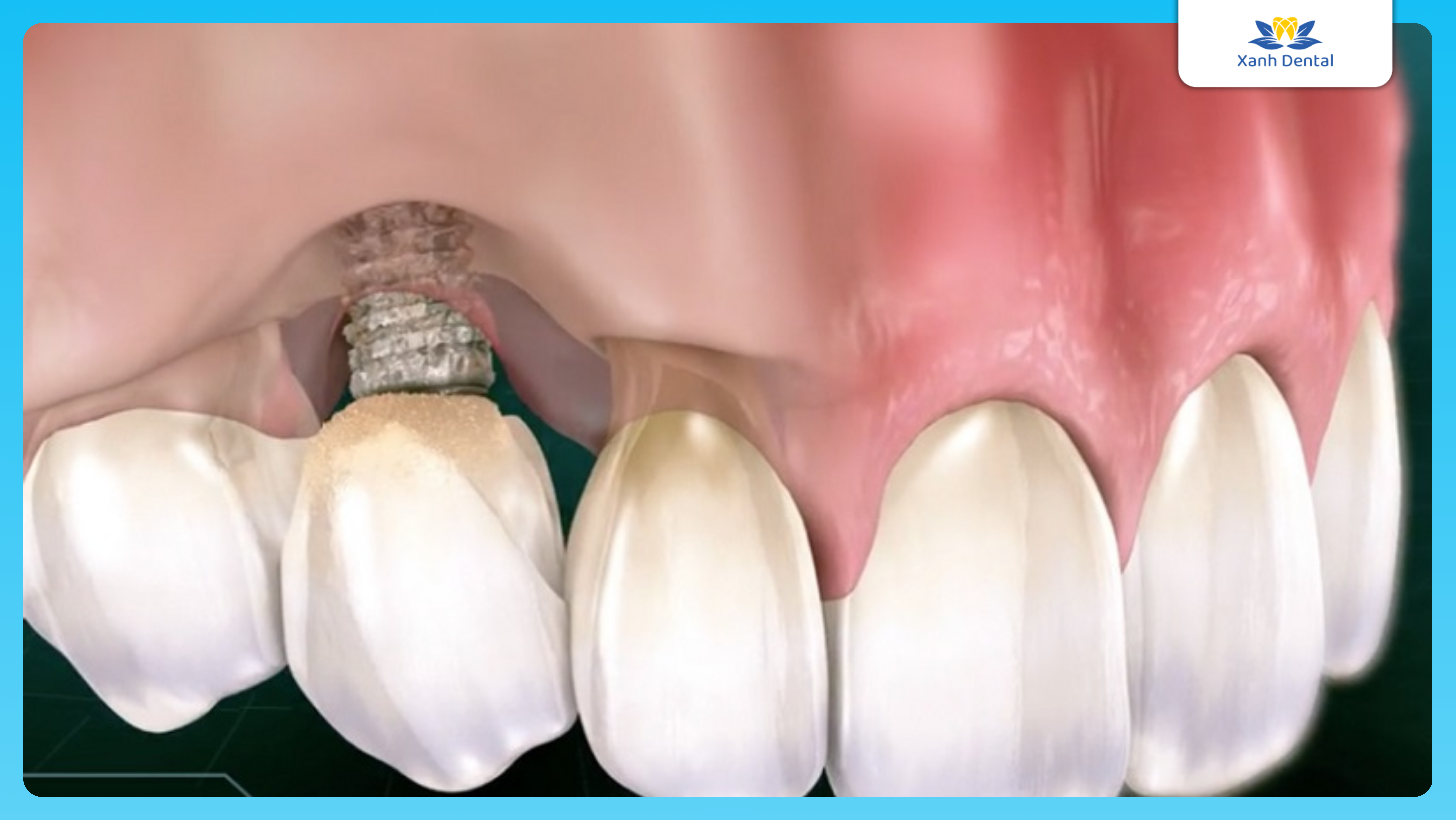 Rủi ro trồng răng giá rẻ! Bạn đã biết chưa?