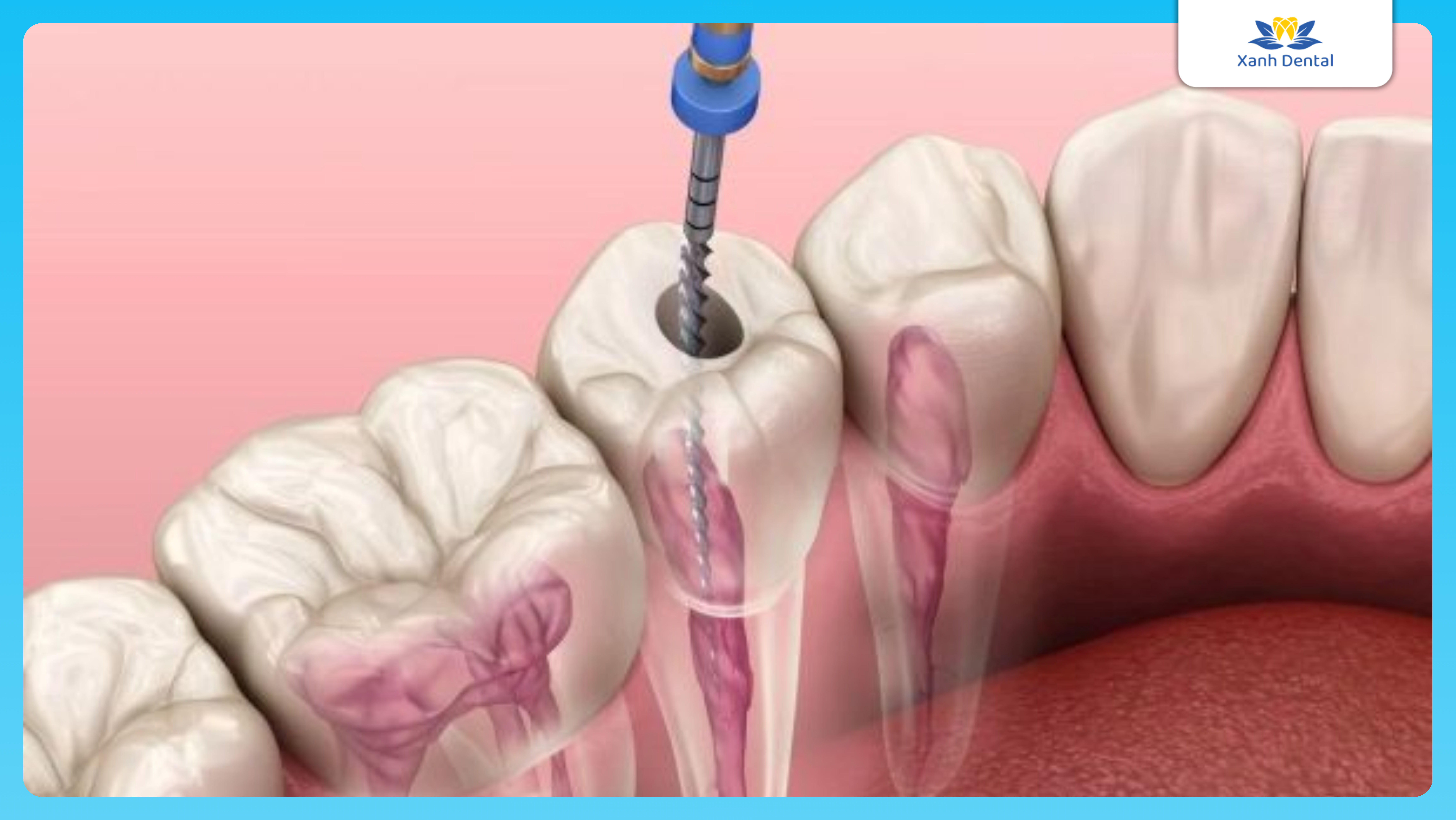 Hàn răng khi điều trị tủy răng. Hàn răng hết bao nhiều