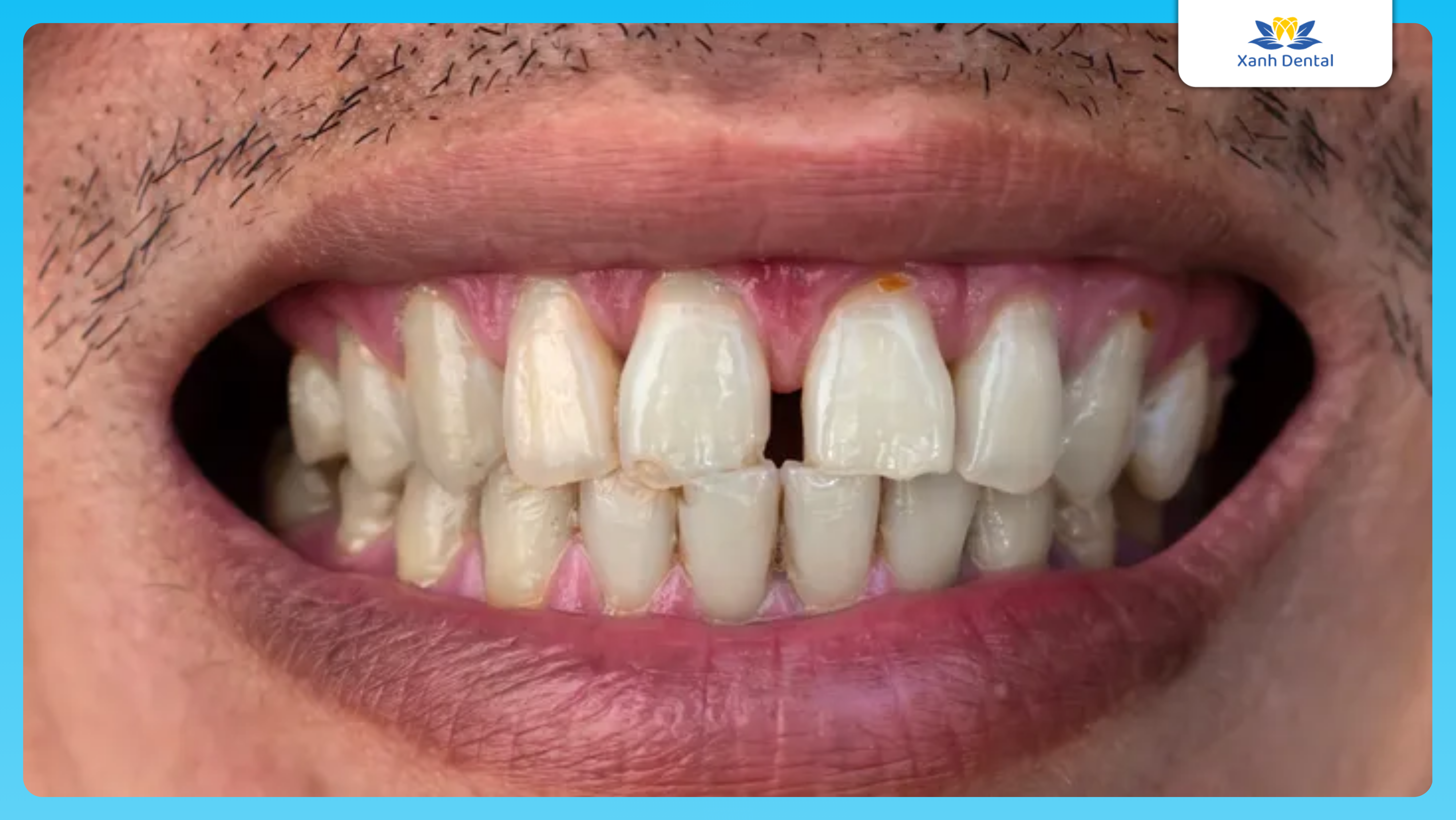Xuất hiện khe hở rộng dắt thức ăn. Hàn răng hết bao nhiều