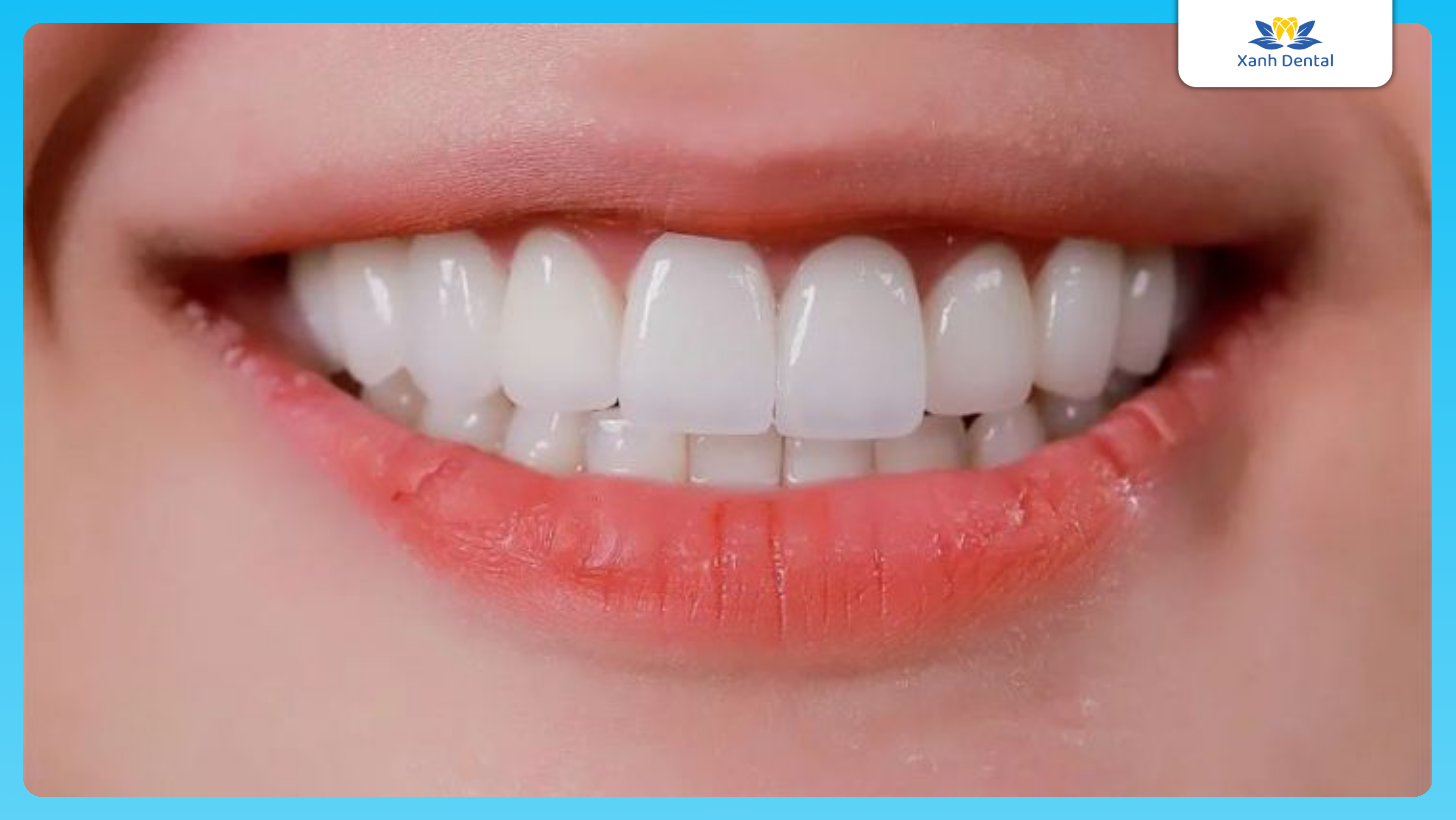 Răng thỏ có tính thẩm mỹ cao