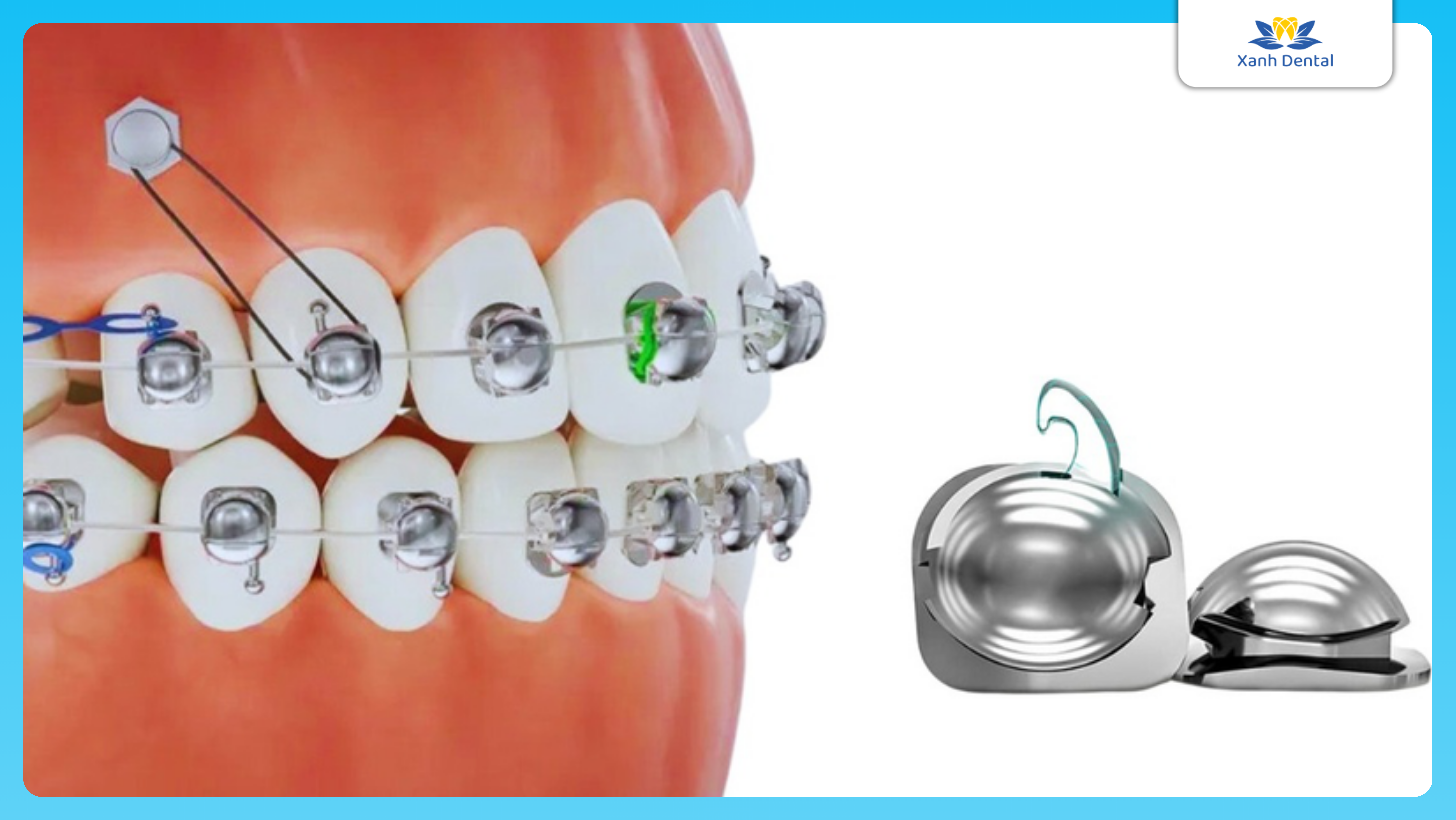 Mắc cài cánh cam công nghệ đột phá trong niềng răng