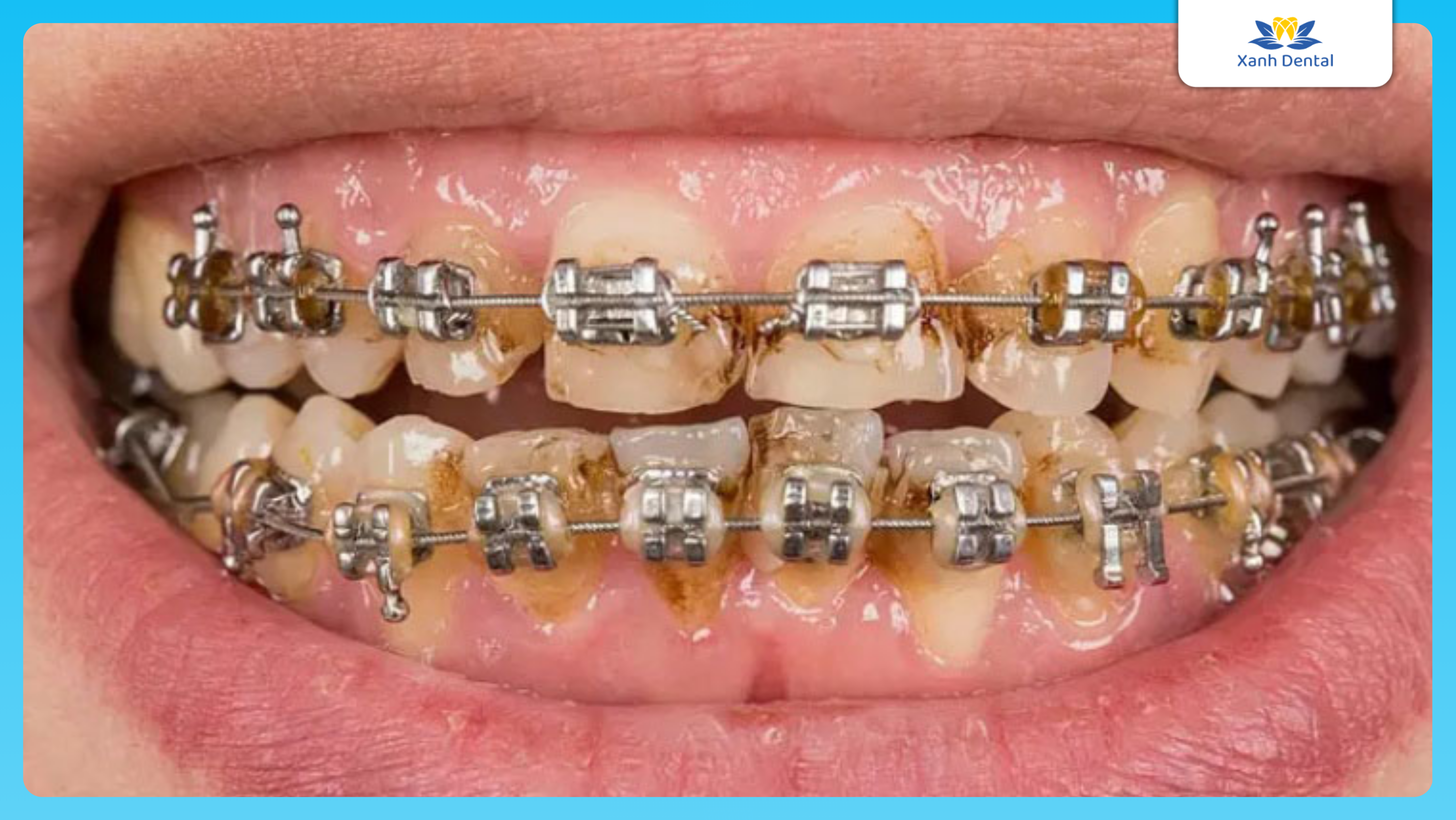 Vệ sinh răng miệng kém dẫn đến niềng hỏng răng