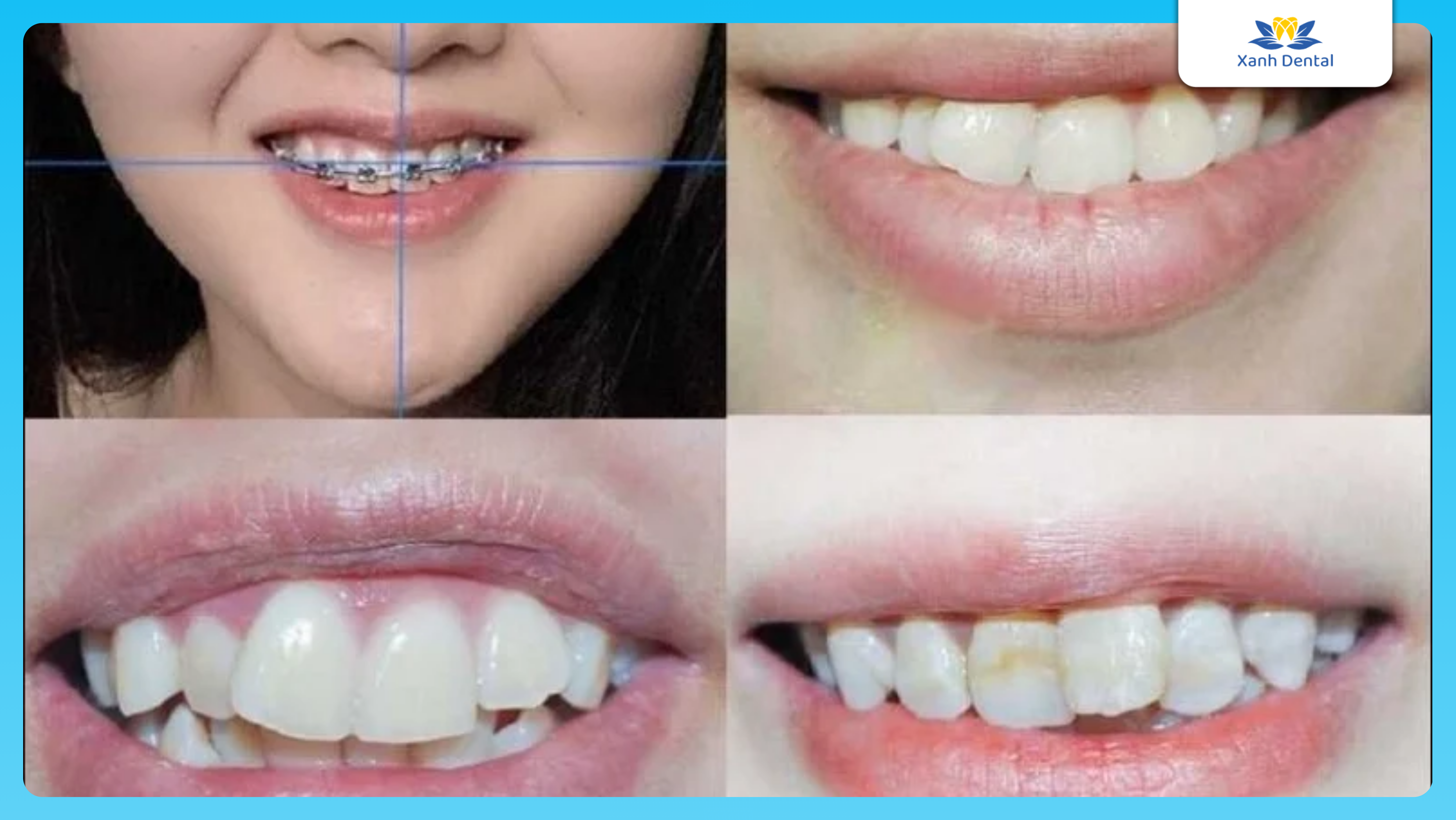 Dấu hiệu nhận biết răng hỏng