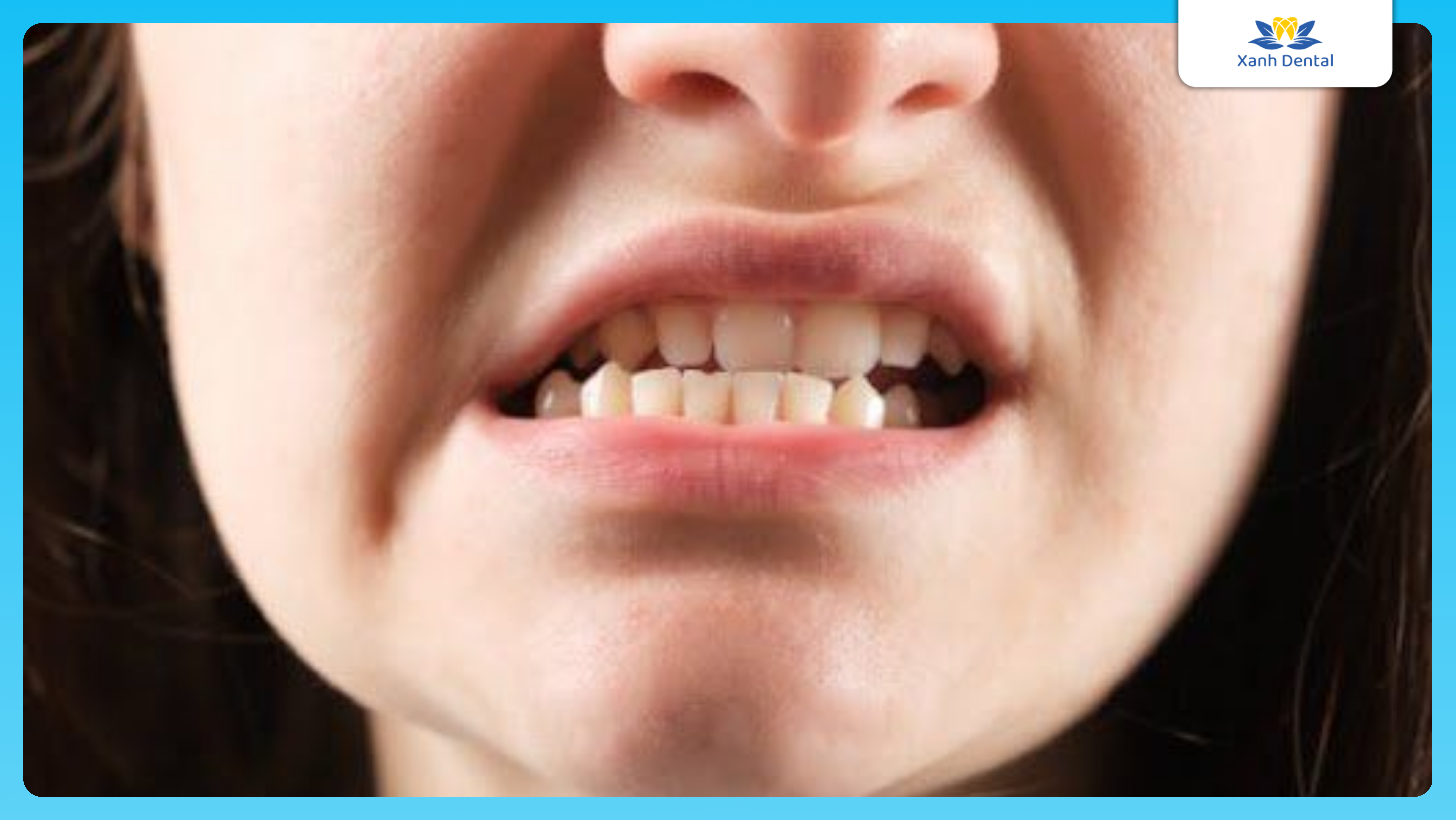 Dấu hiệu niềng răng hỏng: Di răng sai hướng