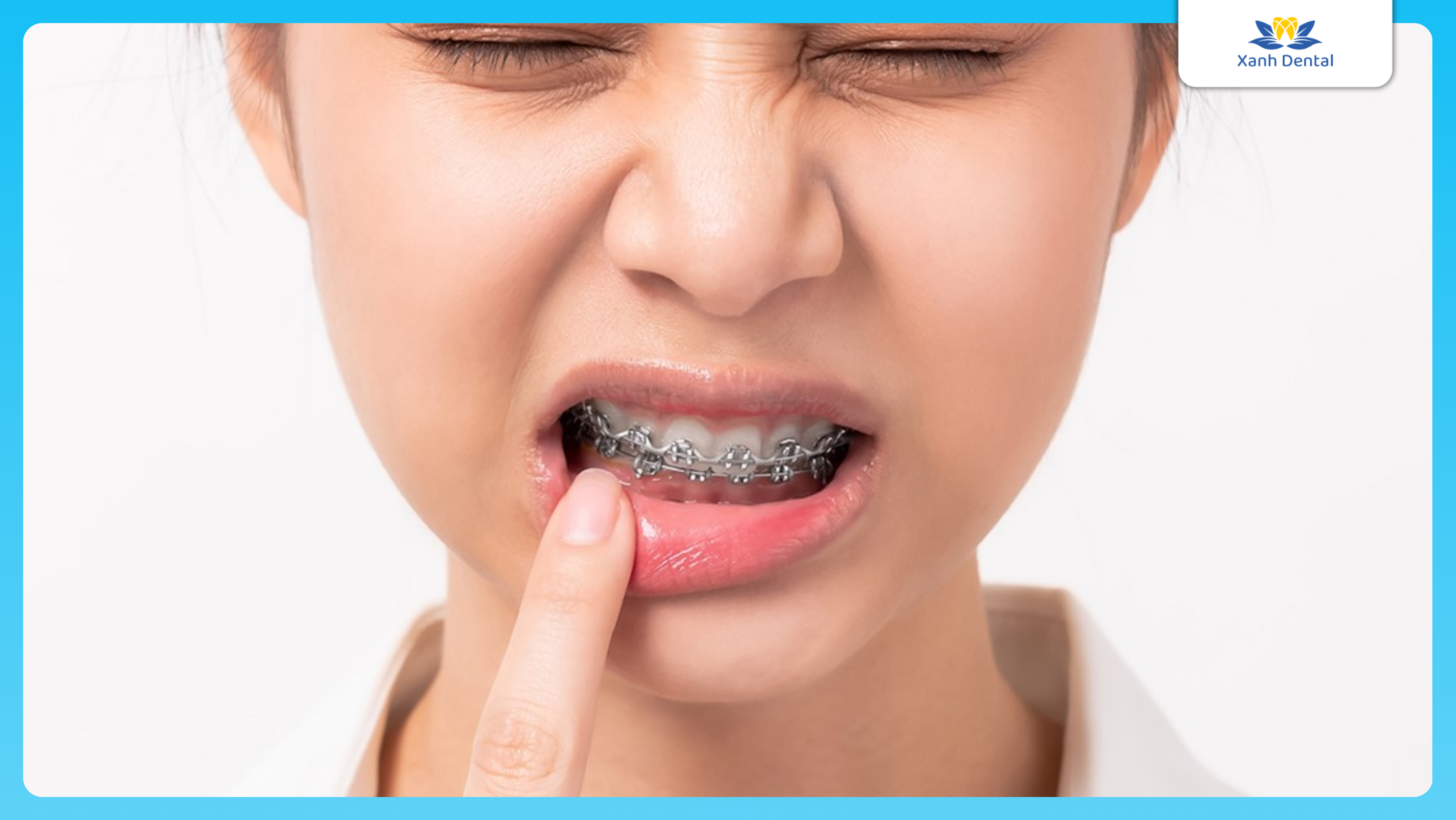 Dấu hiệu niềng răng hỏng: Đau nhức kéo dài