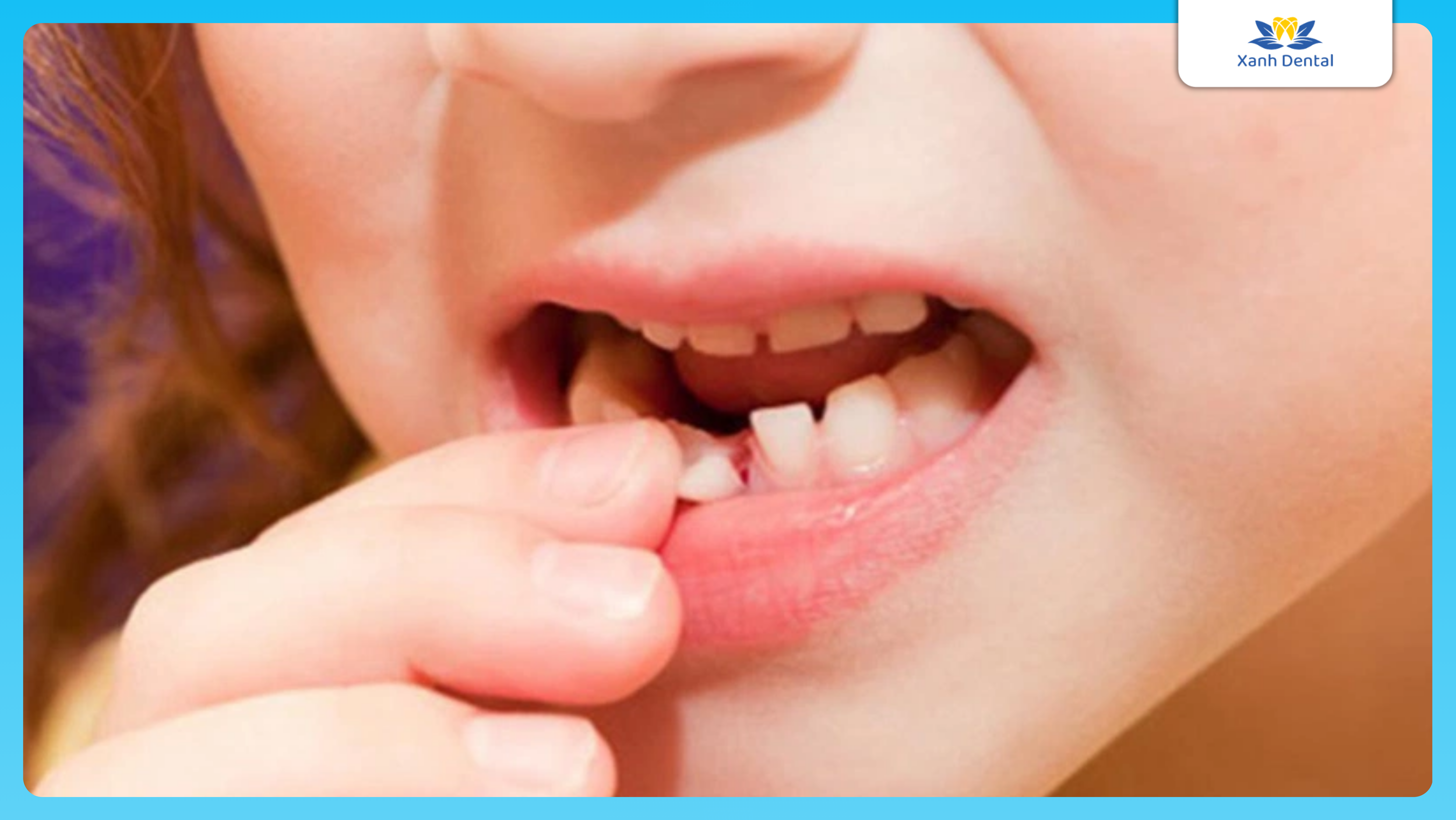 Răng lung lay khi niềng