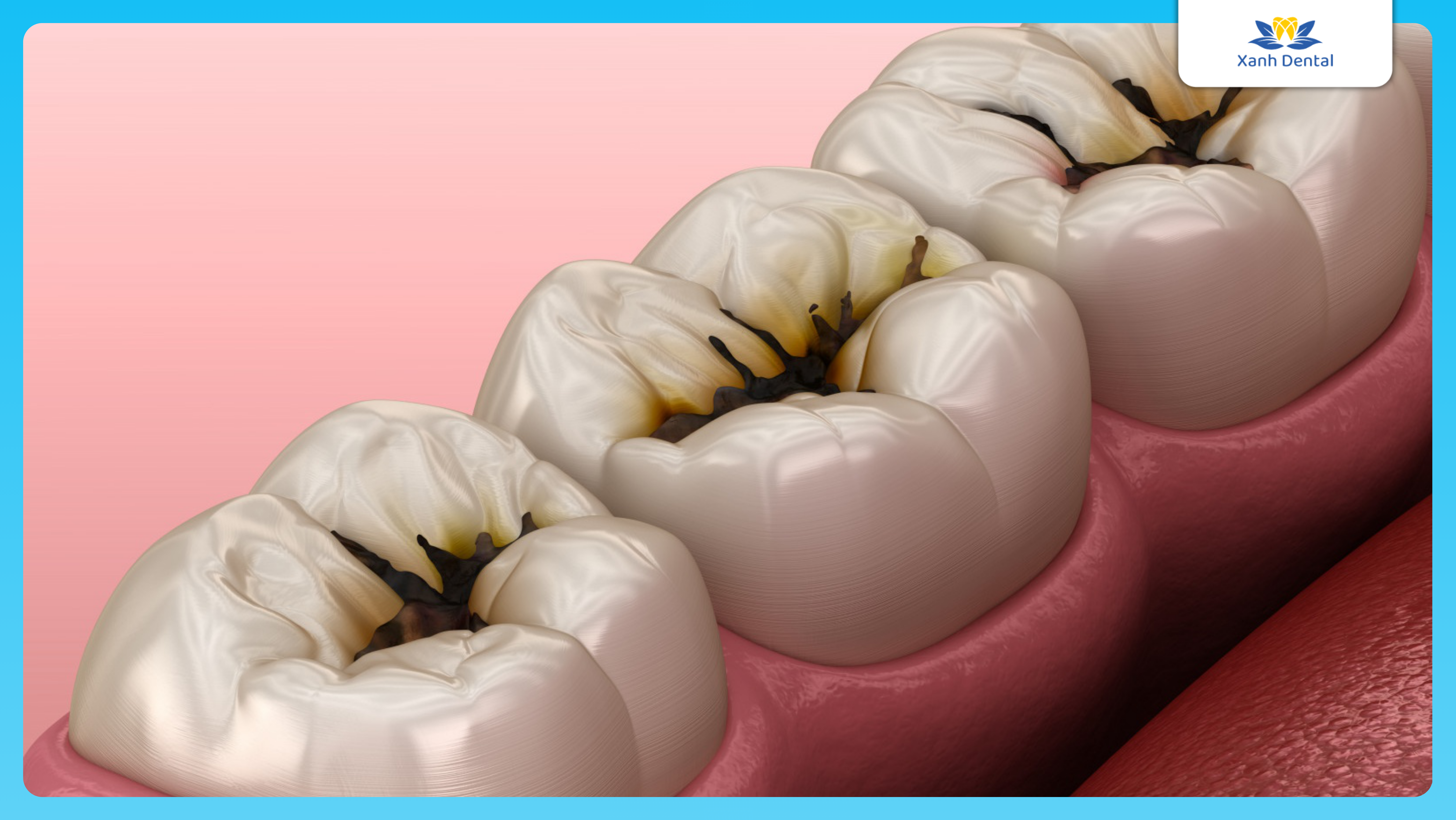 Mức độ sâu răng: Nhận biết và cách xử lý