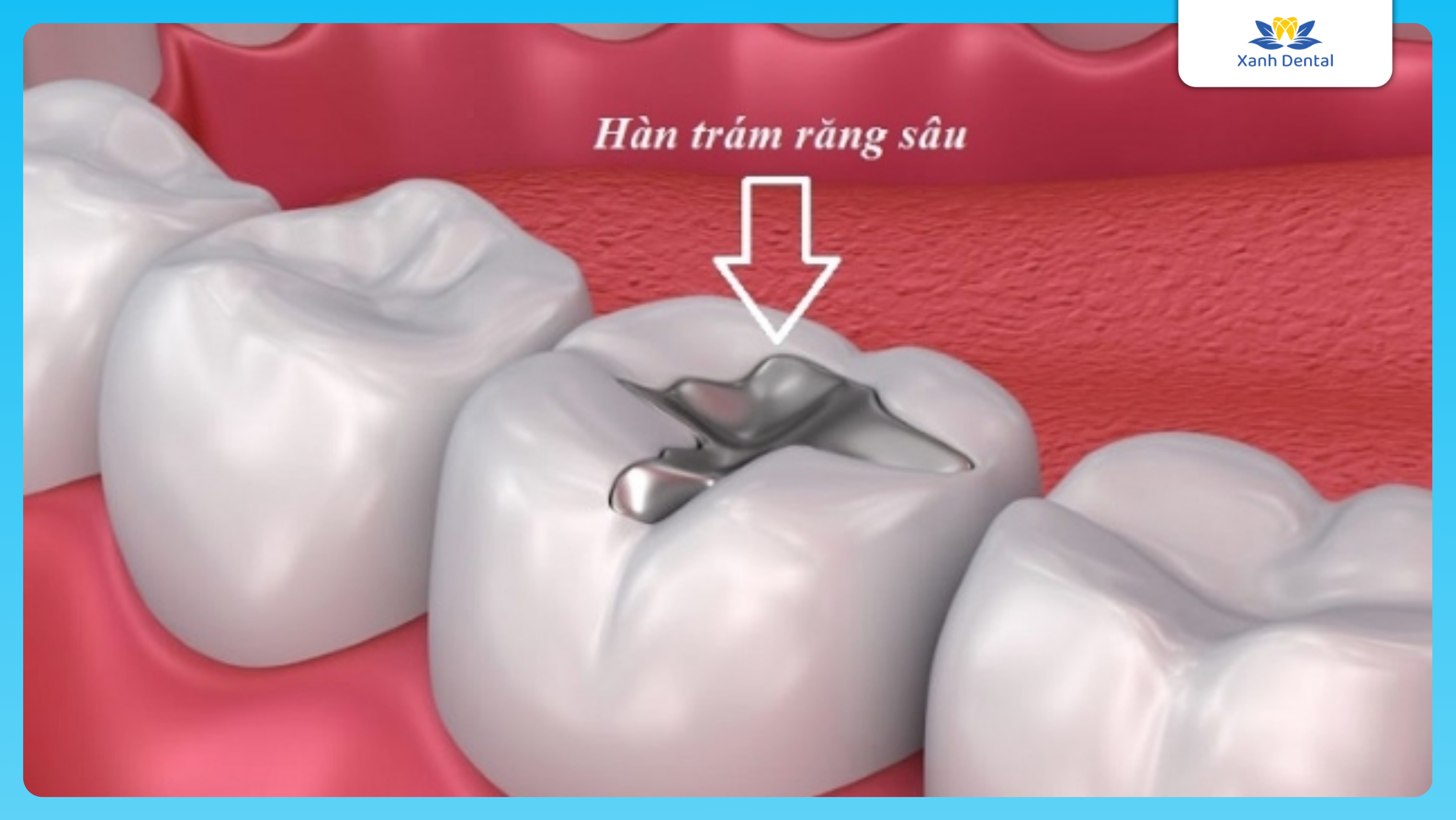 Hàn trám sâu răng cho trẻ em