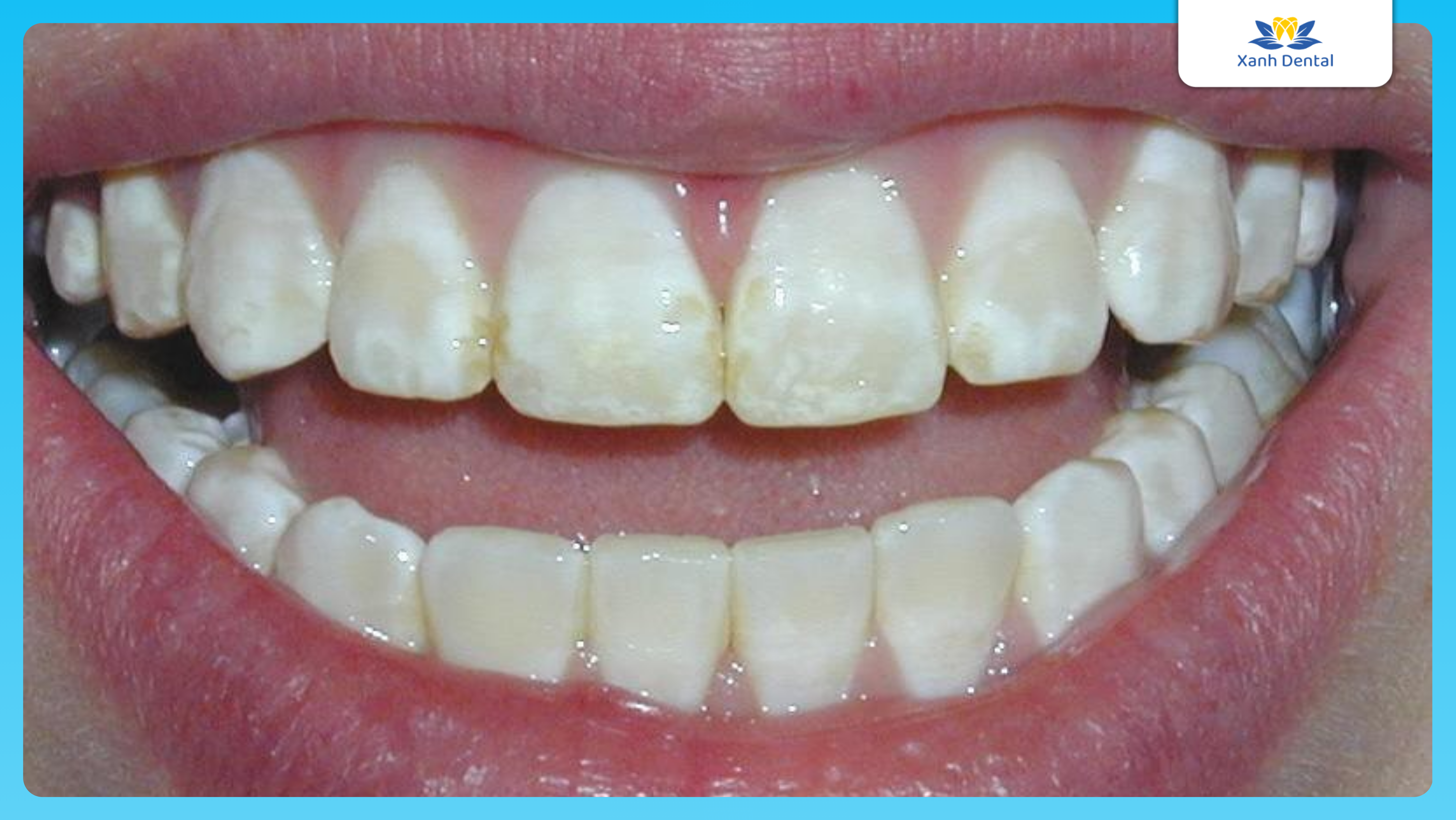 Mức độ sâu răng: Sâu men răng