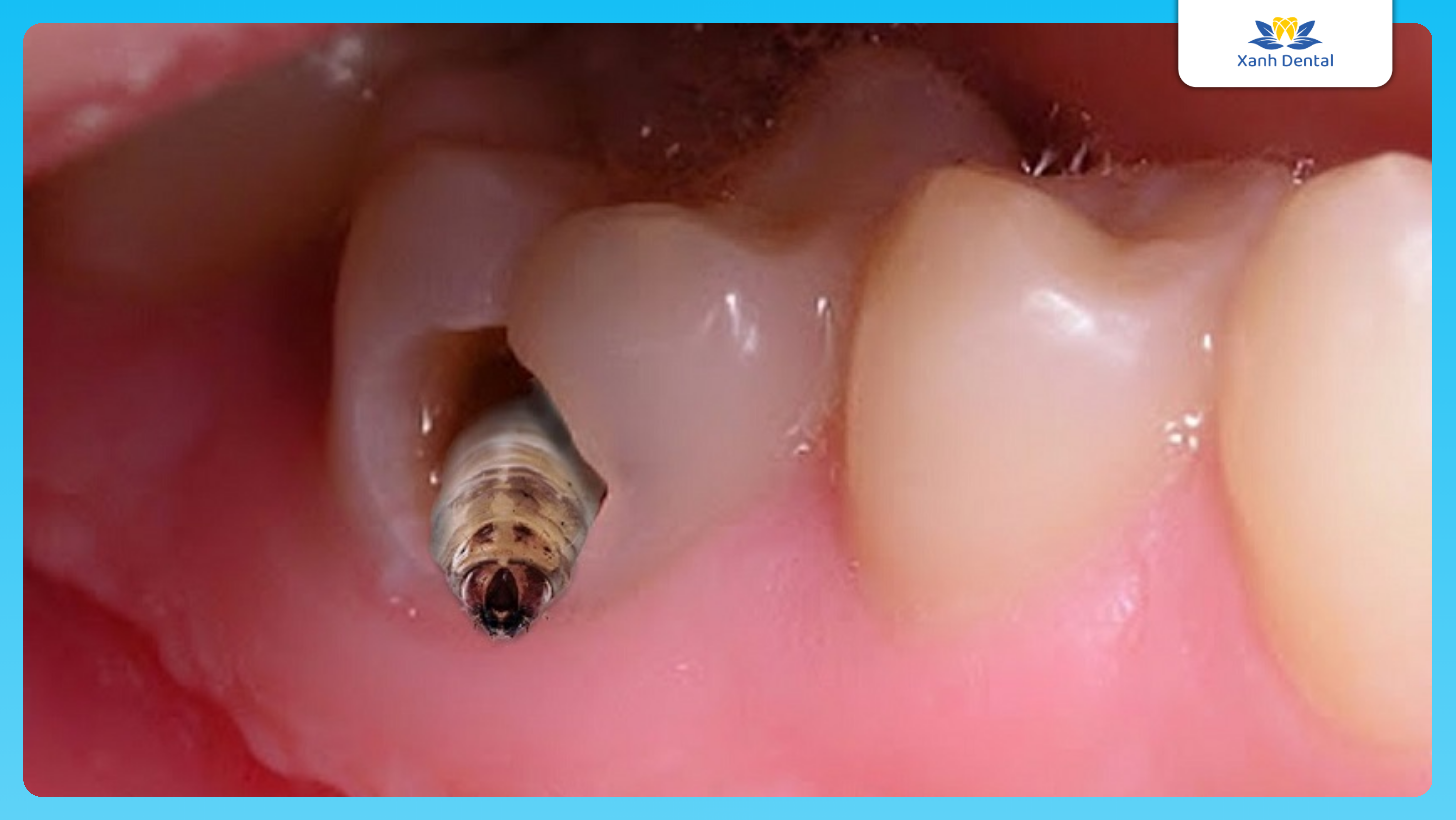 Mức độ sâu răng: Sâu ngà răng