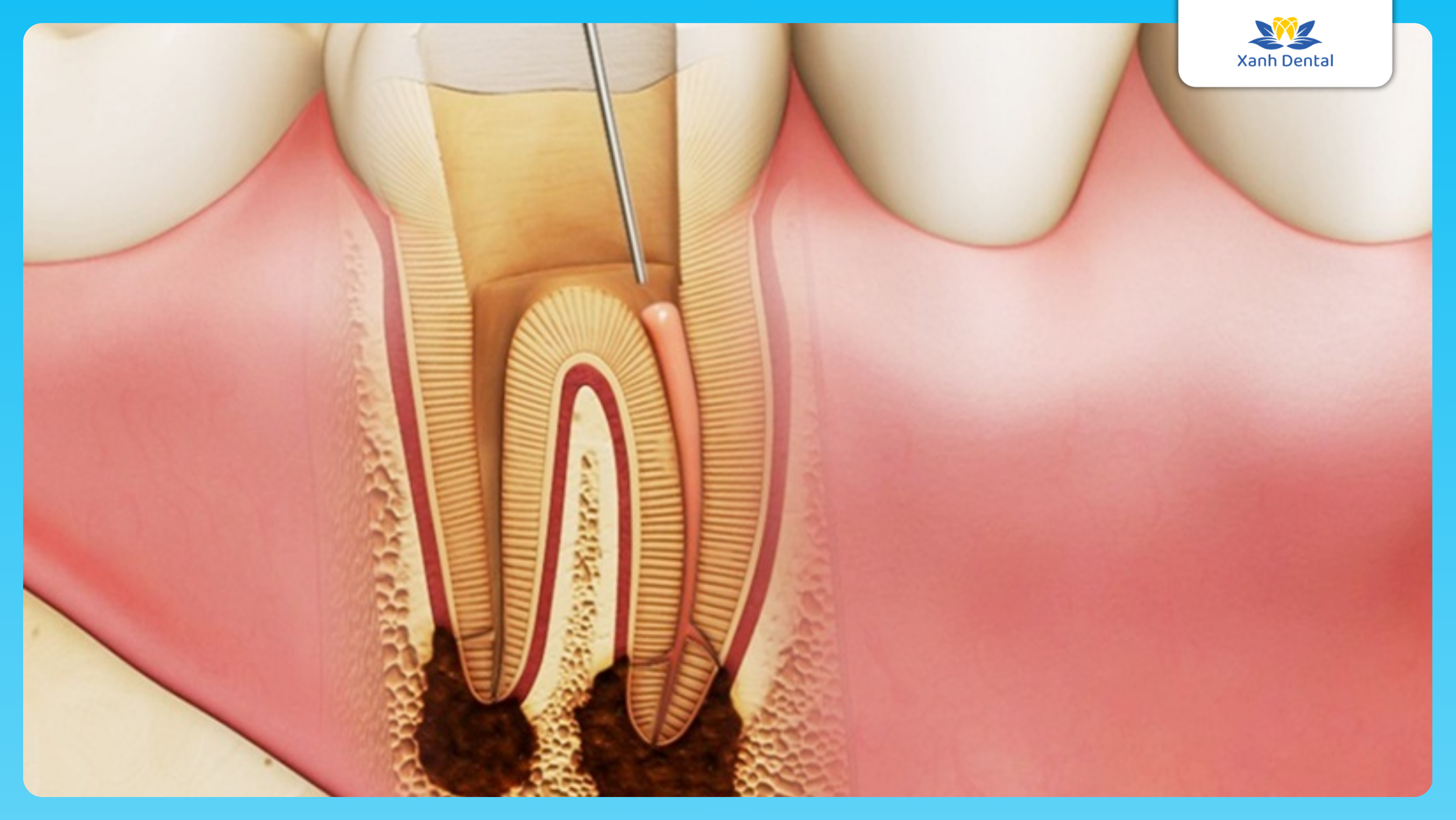 Mức độ sâu răng: Viêm tủy răng